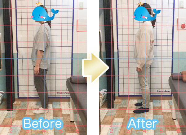 猫背ビフォーアフター