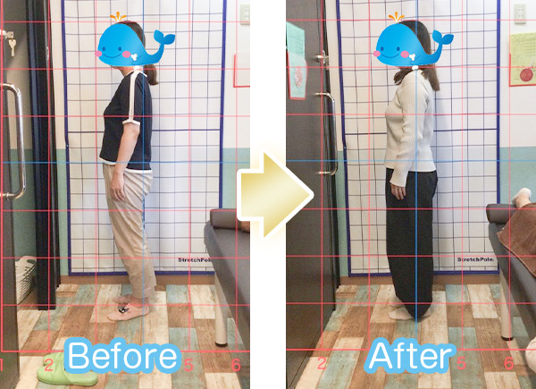 猫背ビフォーアフター