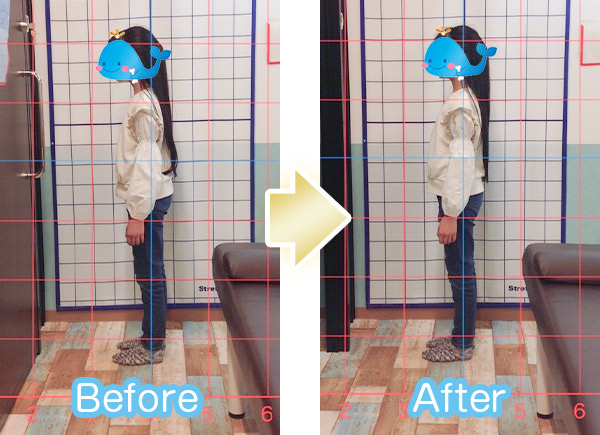 猫背ビフォーアフター