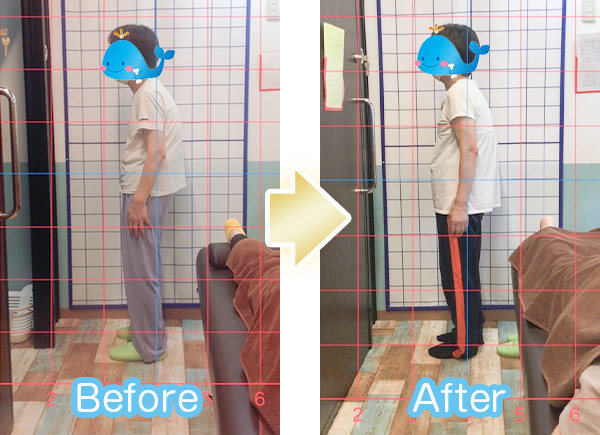 猫背ビフォーアフター