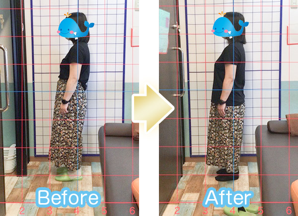 猫背ビフォーアフター