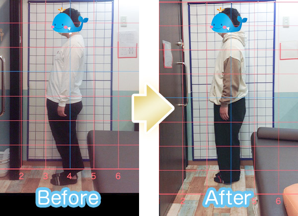 猫背ビフォーアフター